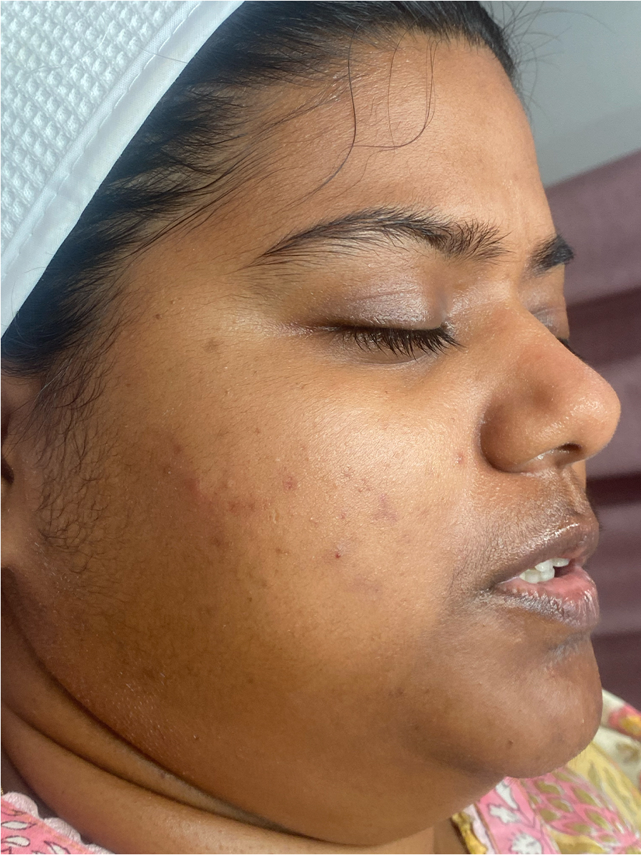 Before treatment