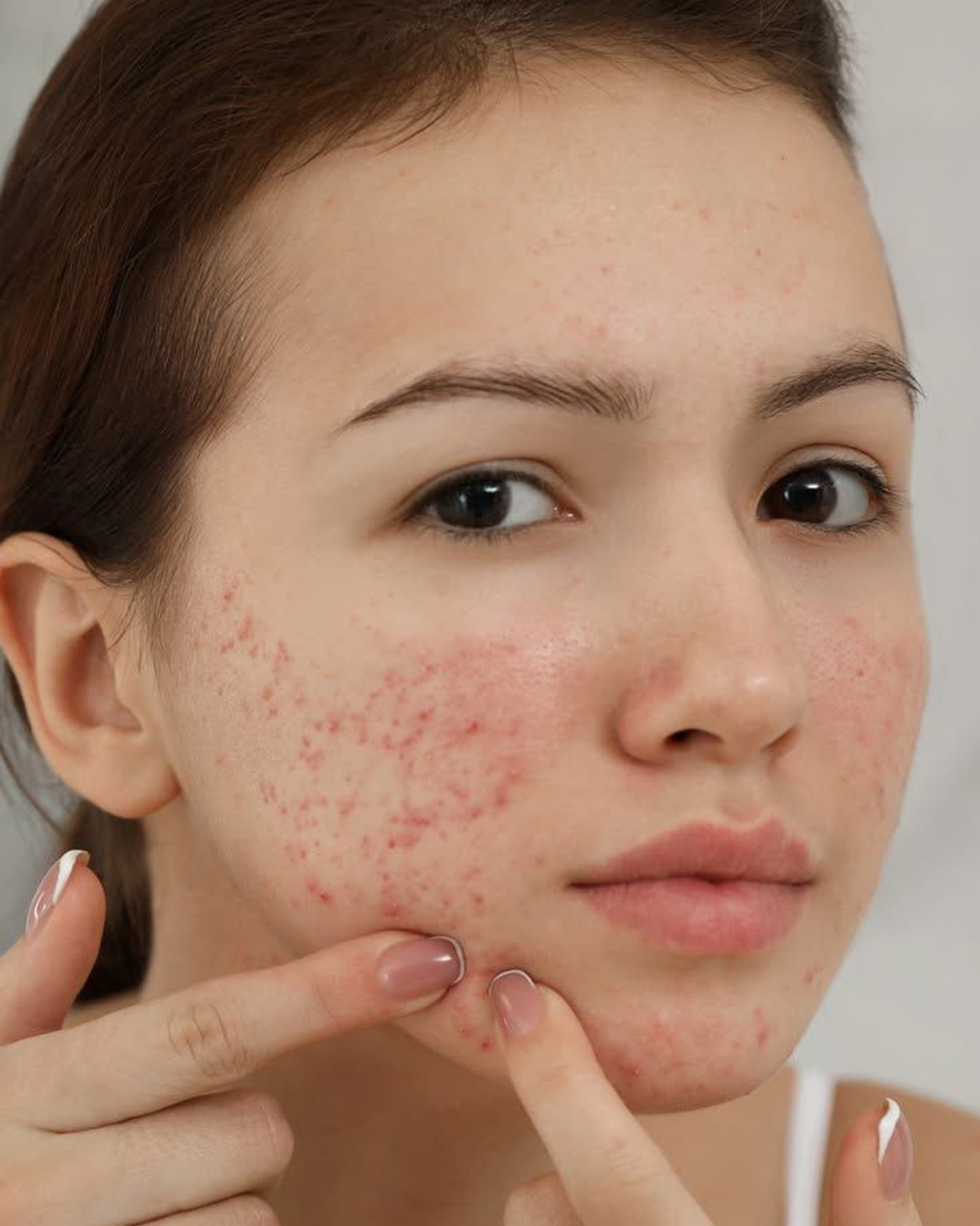 Acne