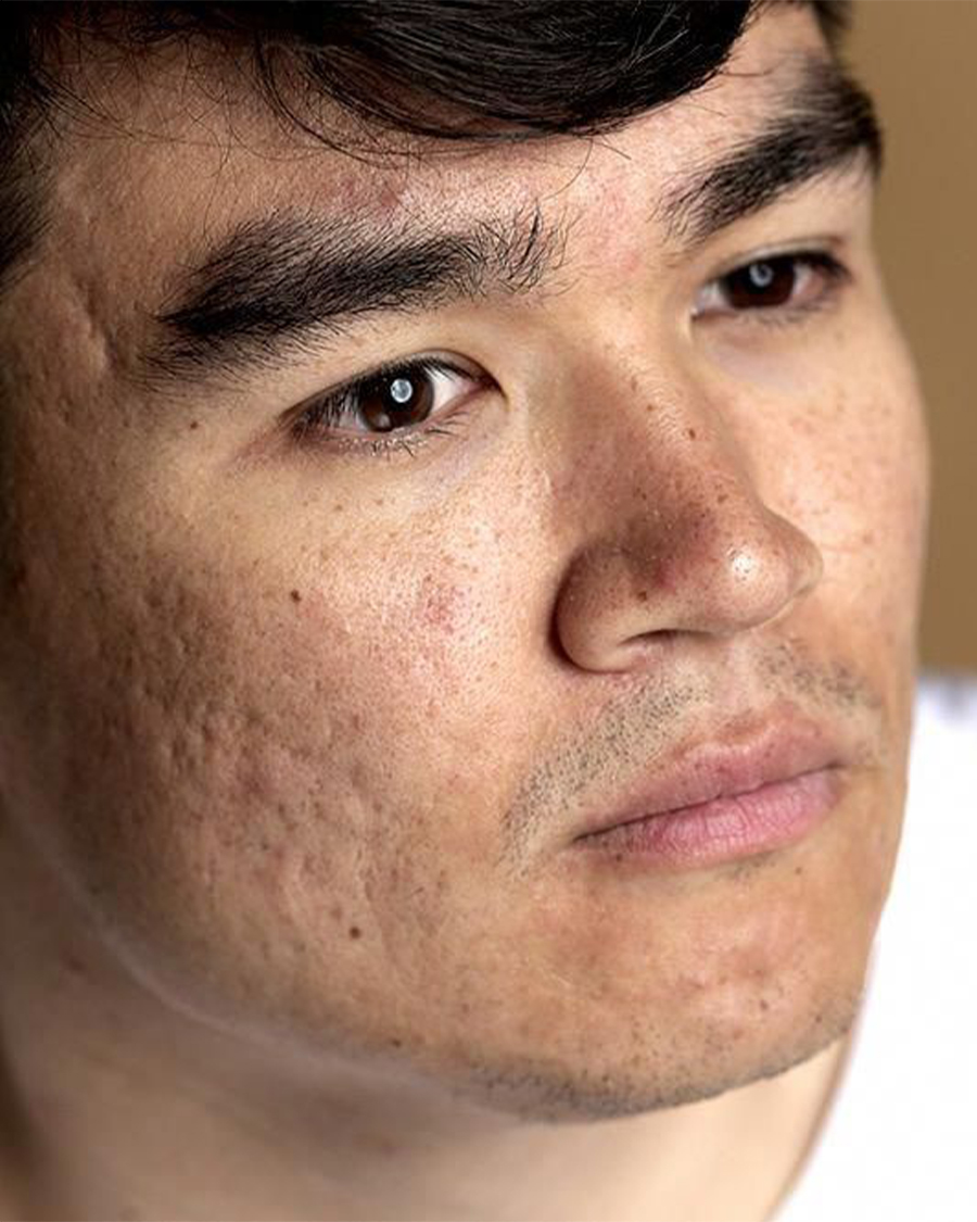 Acne Scar