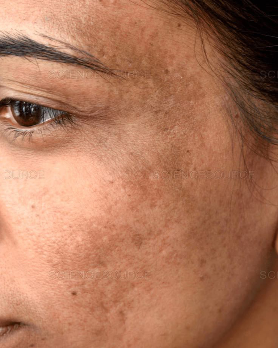 Melasma