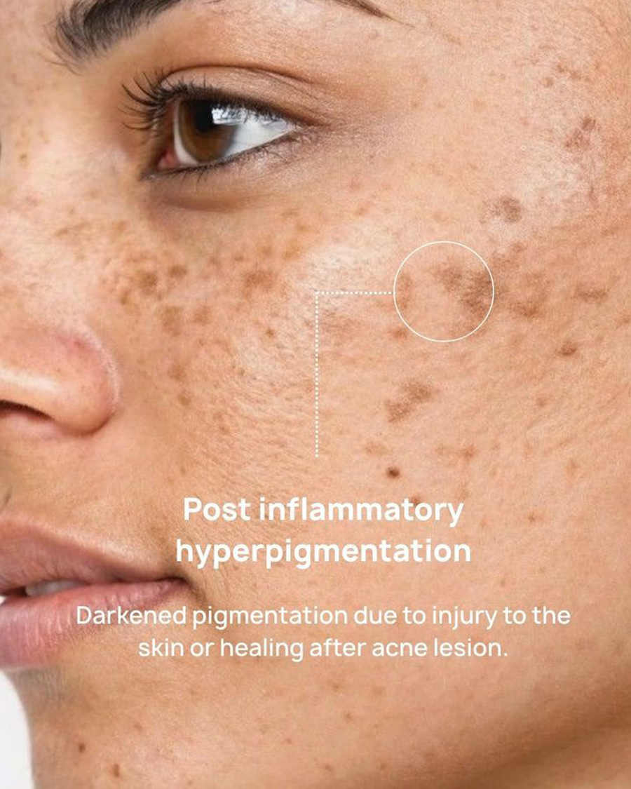 Pigmentation