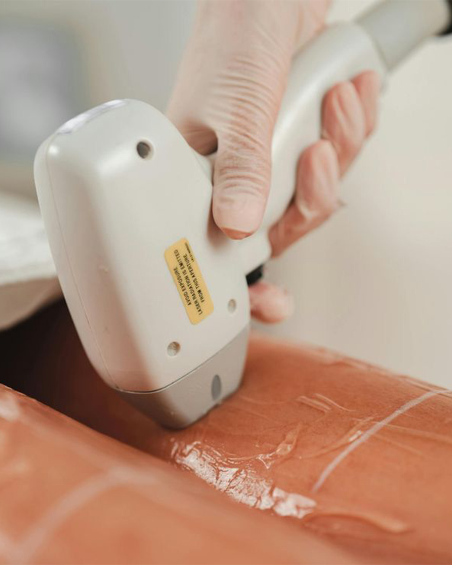 Laser Hair Removal