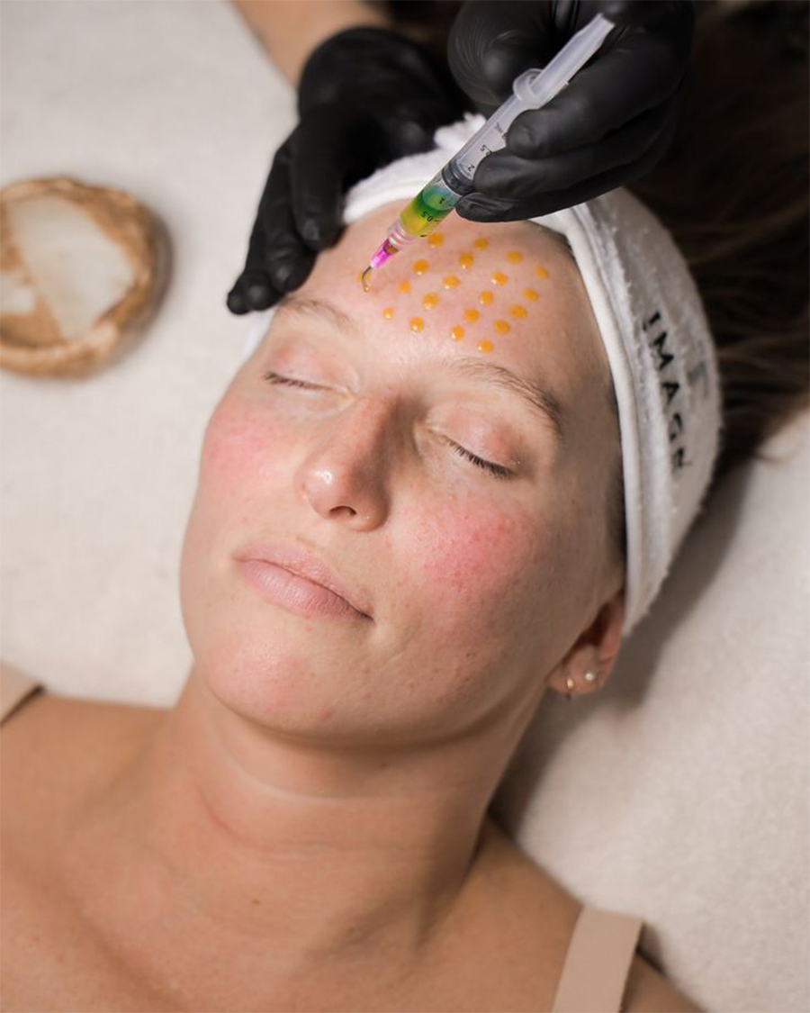 Chemical Peels